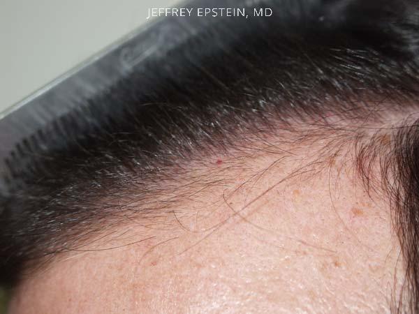 Hairline Transplant Closeups Before and after in Miami, FL, Paciente 37448