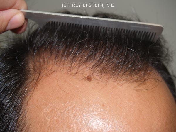 Hairline Transplant Closeups Before and after in Miami, FL, Paciente 37450
