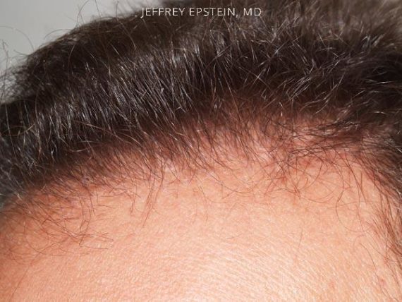 Hairline Transplant Closeups Before and after in Miami, FL, Paciente 37452