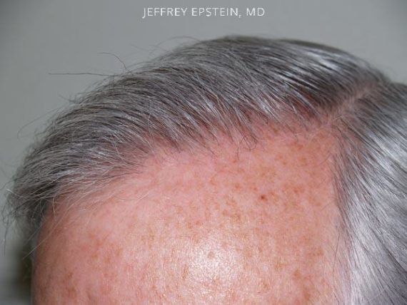 Hairline Transplant Closeups Before and after in Miami, FL, Paciente 37456