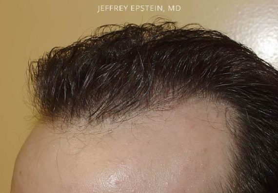 Hairline Closeups Before and after in Miami, FL, Paciente 37458