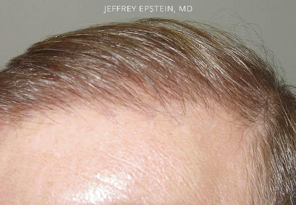 Hairline Transplant Closeups Before and after in Miami, FL, Paciente 37460