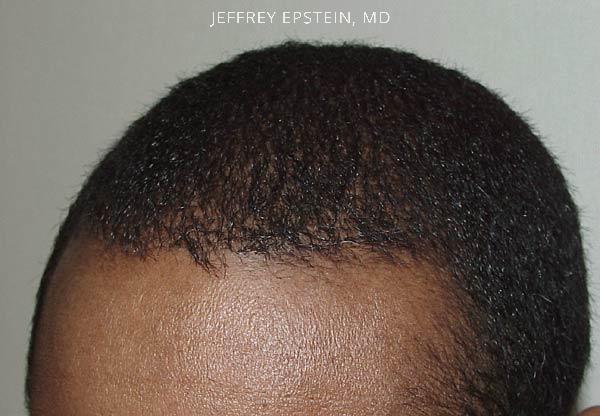 Hairline Closeups Before and after in Miami, FL, Paciente 37462