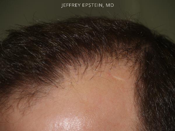 Hairline Transplant Closeups Before and after in Miami, FL, Paciente 37464