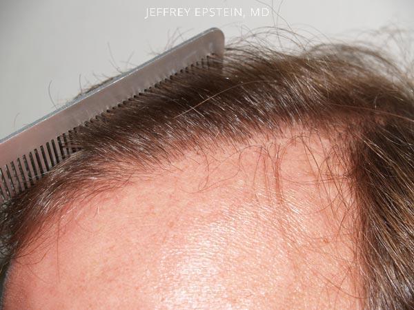 Hairline Transplant Closeups Before and after in Miami, FL, Paciente 37466