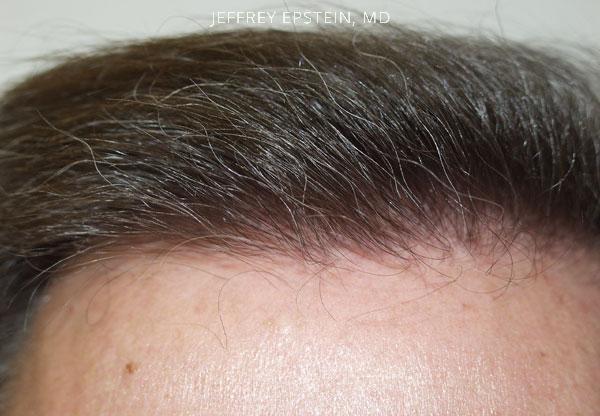 Hairline Transplant Closeups Before and after in Miami, FL, Paciente 37468