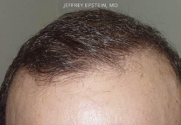 Hairline Transplant Closeups Before and after in Miami, FL, Paciente 37470