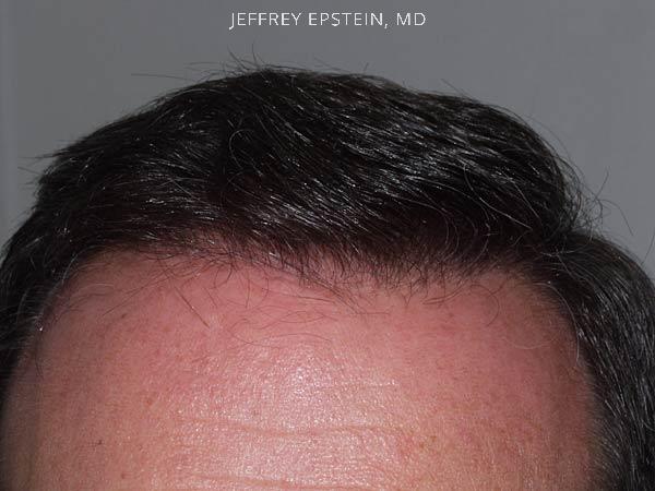 Hairline Transplant Closeups Before and after in Miami, FL, Paciente 37472