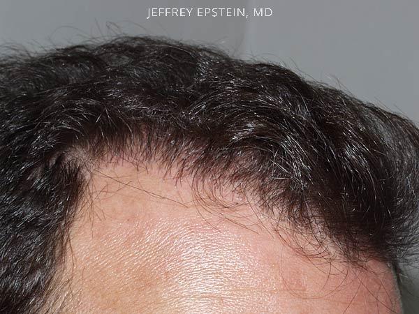 Hairline Transplant Closeups Before and after in Miami, FL, Paciente 37476