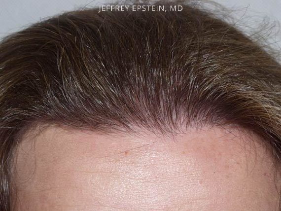 Hairline Transplant Closeups Before and after in Miami, FL, Paciente 37478