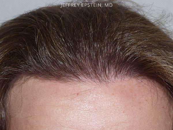 Hairline Transplant Closeups Before and after in Miami, FL, Paciente 37478