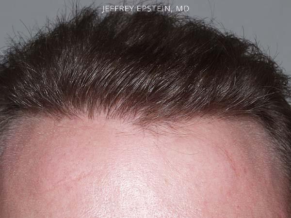 Hairline Transplant Closeups Before and after in Miami, FL, Paciente 37480