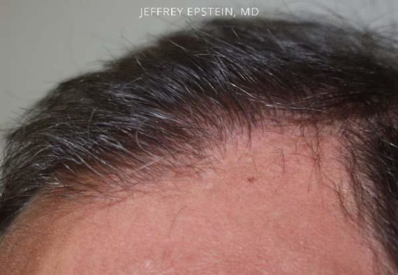 Hairline Closeups Before and after in Miami, FL, Paciente 37482