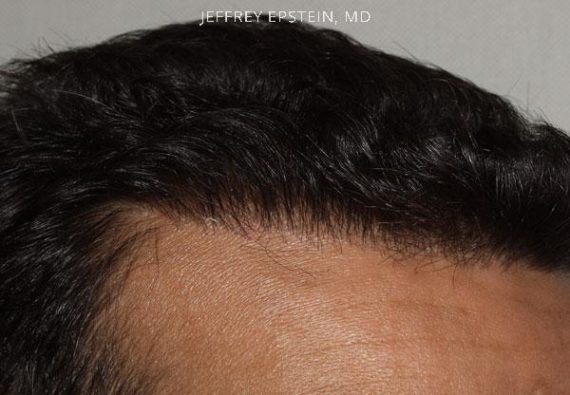 Hairline Closeups Before and after in Miami, FL, Paciente 37484