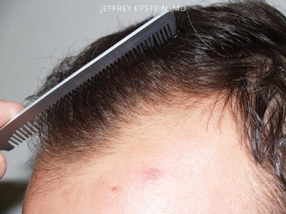 Hairline Transplant Closeups Before and after in Miami, FL, Paciente 37486