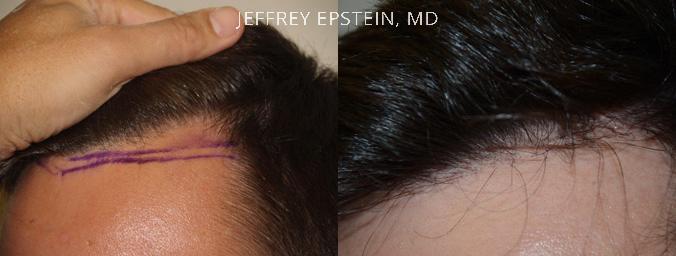 Hairline Transplant Closeups Before and after in Miami, FL, Paciente 37488