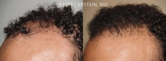Hairline Transplant Closeups Before and after in Miami, FL, Paciente 37491
