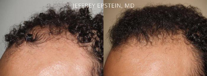 Hairline Transplant Closeups Before and after in Miami, FL, Paciente 37491