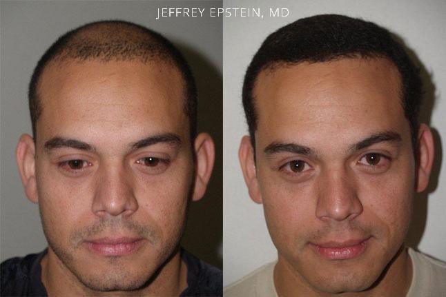 Hair Transplants for Men Before and after in Miami, FL, Paciente 37494
