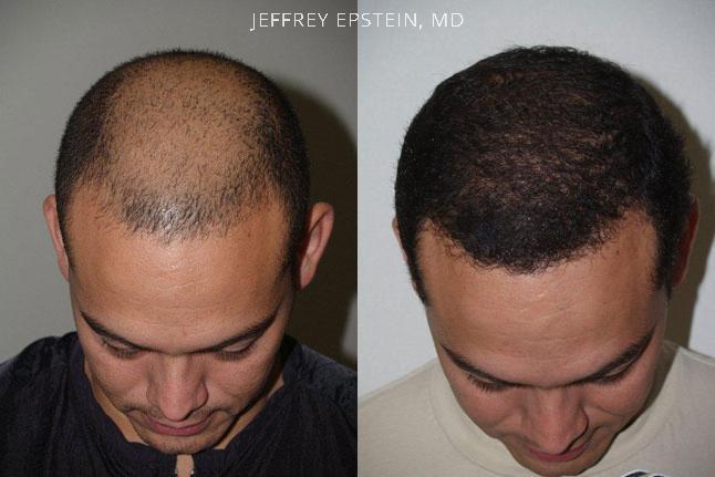 Hair Transplants for Men Before and after in Miami, FL, Paciente 37494