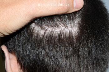 Hair Transplants for Men Before and after in Miami, FL, Paciente 37499