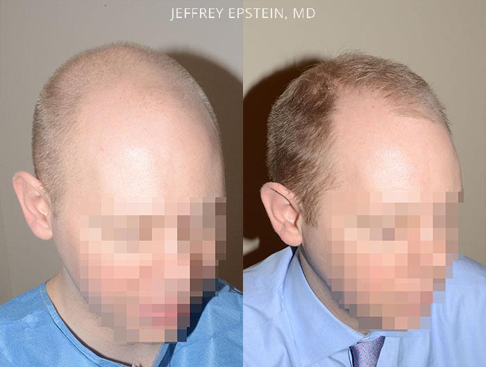 Hair Transplants for Men Before and after in Miami, FL, Paciente 37511