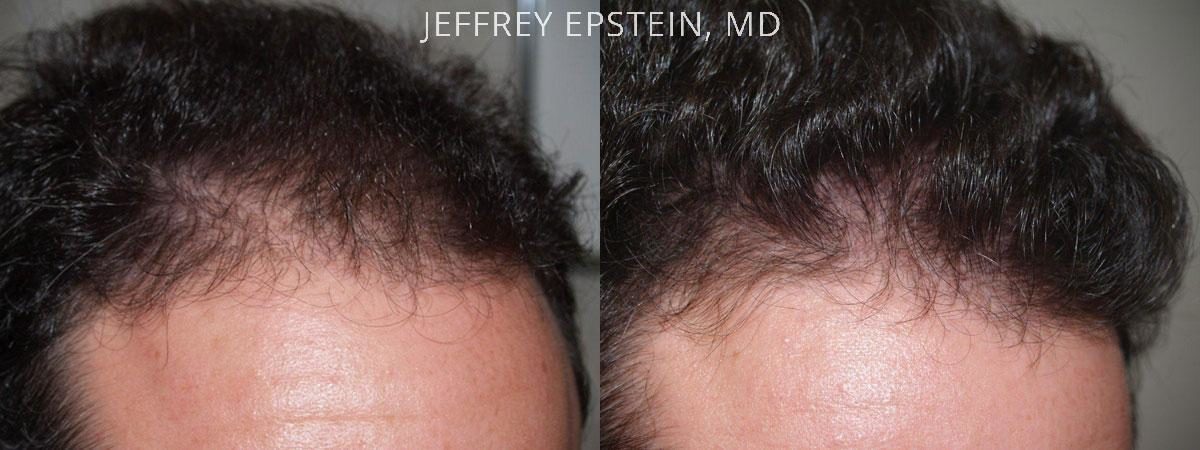 Hair Transplants for Men Before and after in Miami, FL, Paciente 37520