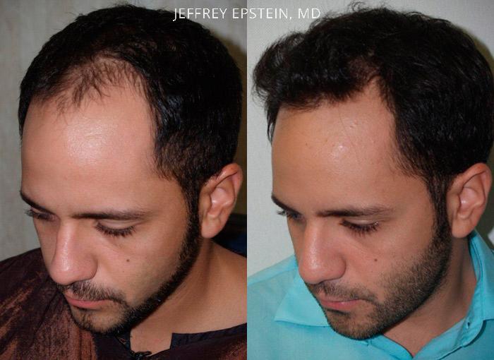 Trasplante de Pelo en Hombres Antes y después en Miami, FL, Paciente 90594