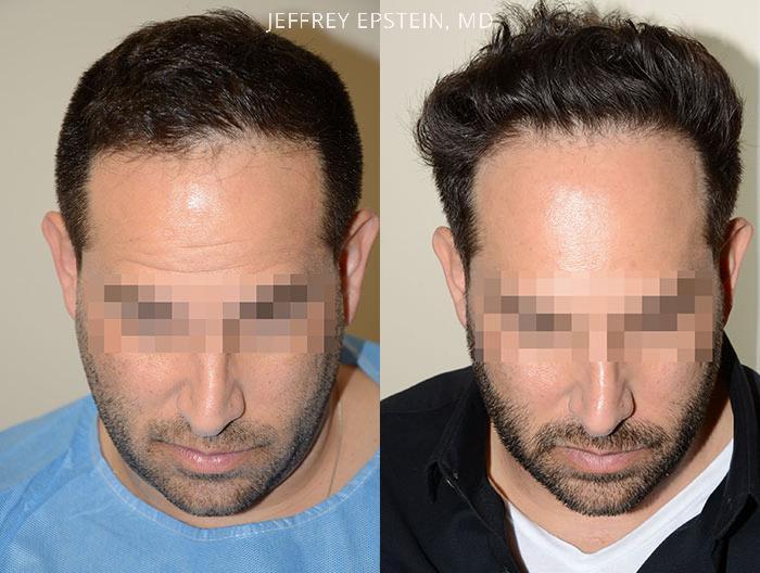 Hair Transplants for Men Before and after in Miami, FL, Paciente 37541