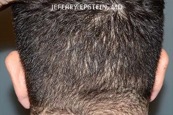 Hair Transplants for Men Before and after in Miami, FL, Paciente 37541