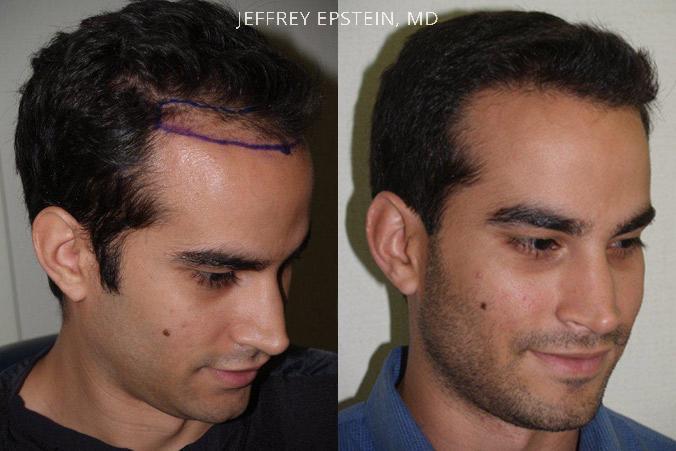 Hair Transplants for Men Before and after in Miami, FL, Paciente 37551