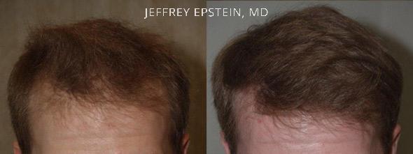 Hair Transplants for Men Before and after in Miami, FL, Paciente 37558
