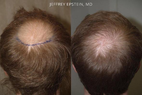 Hair Transplants for Men Before and after in Miami, FL, Paciente 37558