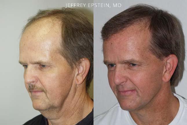 Hair Transplants for Men Before and after in Miami, FL, Paciente 37565