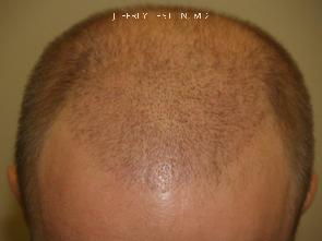 Hair Transplants for Men Before and after in Miami, FL, Paciente 37570