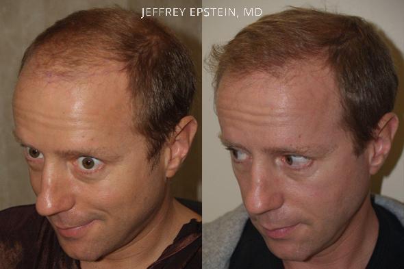 Hair Transplants for Men Before and after in Miami, FL, Paciente 37570
