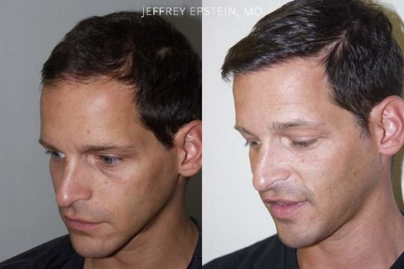Hair Transplants for Men Before and after in Miami, FL, Paciente 37593