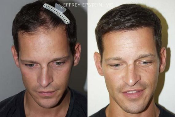 Hair Transplants for Men Before and after in Miami, FL, Paciente 37593