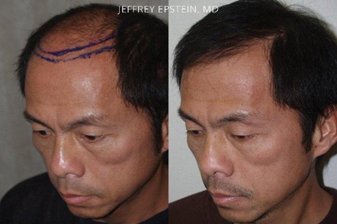 Hair Transplants for Men Before and after in Miami, FL, Paciente 37604