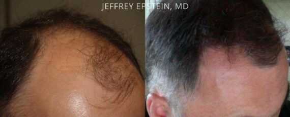 Trasplante de Pelo en Hombres Before and after in Miami, FL, Paciente 89978