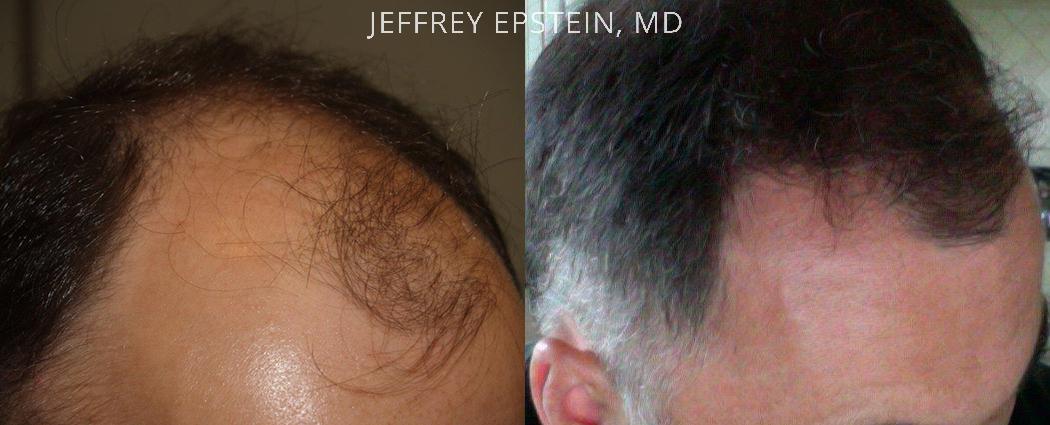 Trasplante de Pelo en Hombres Antes y después en Miami, FL, Paciente 89978