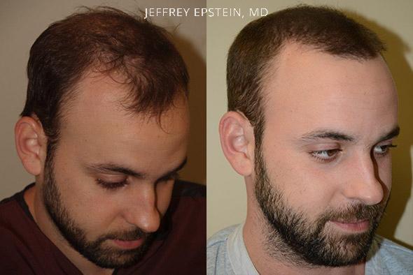 Hair Transplants for Men Before and after in Miami, FL, Paciente 37640