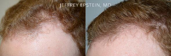 Hair Transplants for Men Before and after in Miami, FL, Paciente 37650