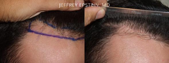 Hair Transplants for Men Before and after in Miami, FL, Paciente 37667