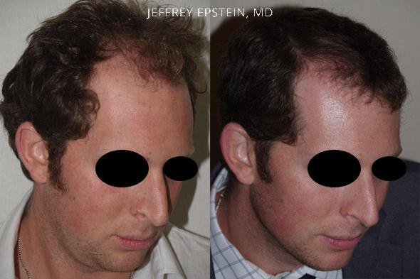 Hair Transplants for Men Before and after in Miami, FL, Paciente 37679