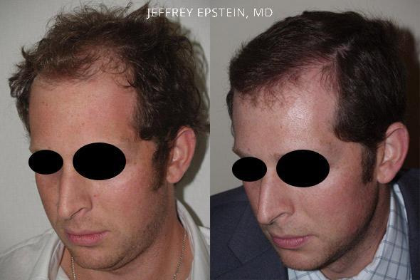 Hair Transplants for Men Before and after in Miami, FL, Paciente 37679