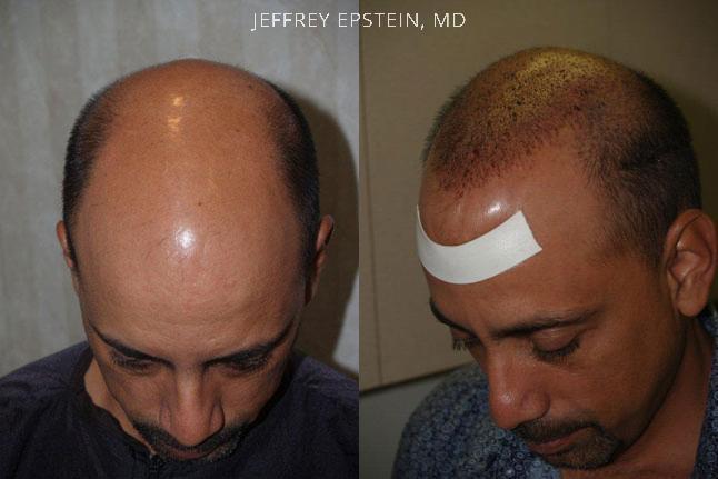 Hair Transplants for Men Before and after in Miami, FL, Paciente 37691