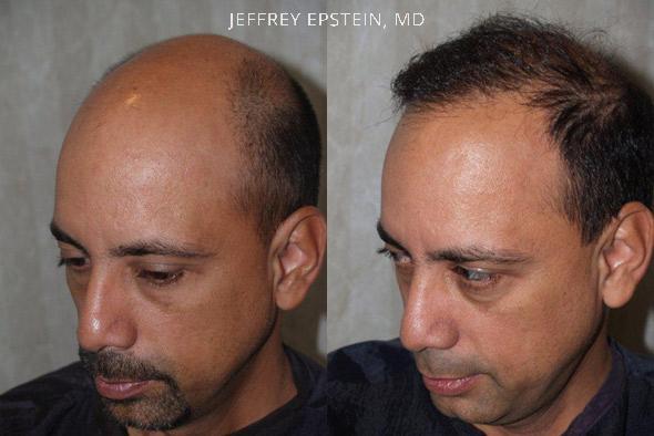 Hair Transplants for Men Before and after in Miami, FL, Paciente 37691