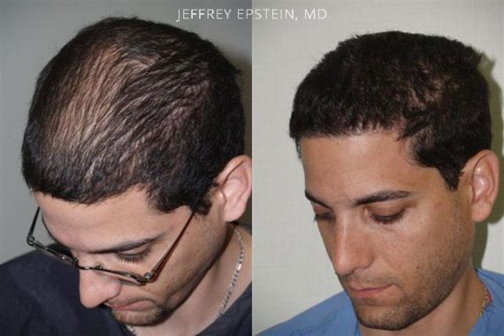 Trasplante de Pelo en Hombres Before and after in Miami, FL, Paciente 89326