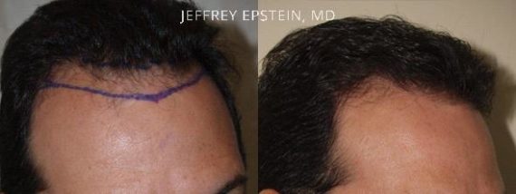 Trasplante de Pelo en Hombres Before and after in Miami, FL, Paciente 89279